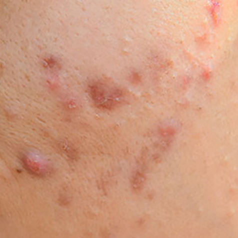 Acne & Acne Scar treatment options at SF Bay Cosmetic Surgery Medical Group in San Ramon