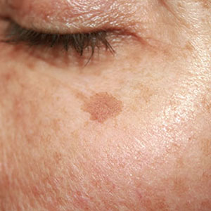Age Spots & Sun Spots treatment options at SF Bay Cosmetic Surgery Medical Group in San Ramon