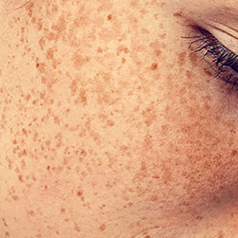 Freckling treatment options at SF Bay Cosmetic Surgery Medical Group in San Ramon