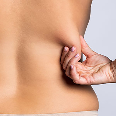 Love Handles treatment options at SF Bay Cosmetic Surgery Medical Group in San Ramon