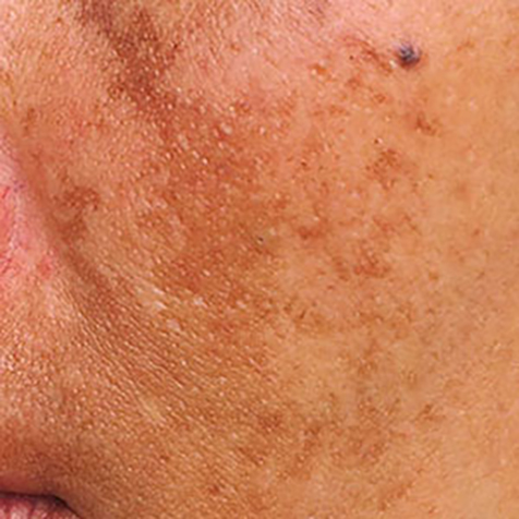 Image of patient struggling with Melasma