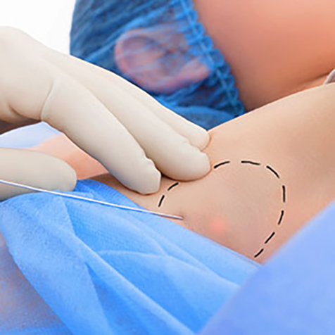 Treat saggy skin with our Thermitight® at SF Bay Cosmetic Surgery Medical Group in San Ramon