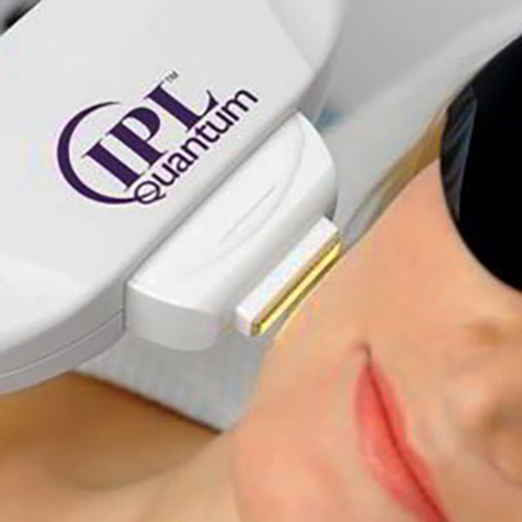 Treat Sun Damage with our IPL Photo Facial at SF Bay Cosmetic Surgery Medical Group in San Ramon