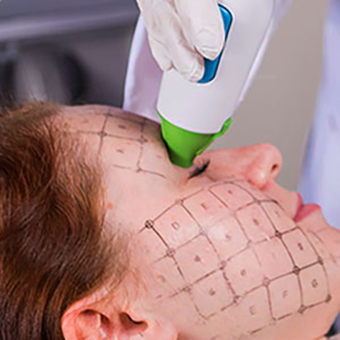 Treat Saggy Skin with our Thermage® Face at SF Bay Cosmetic Surgery Medical Group in San Ramon