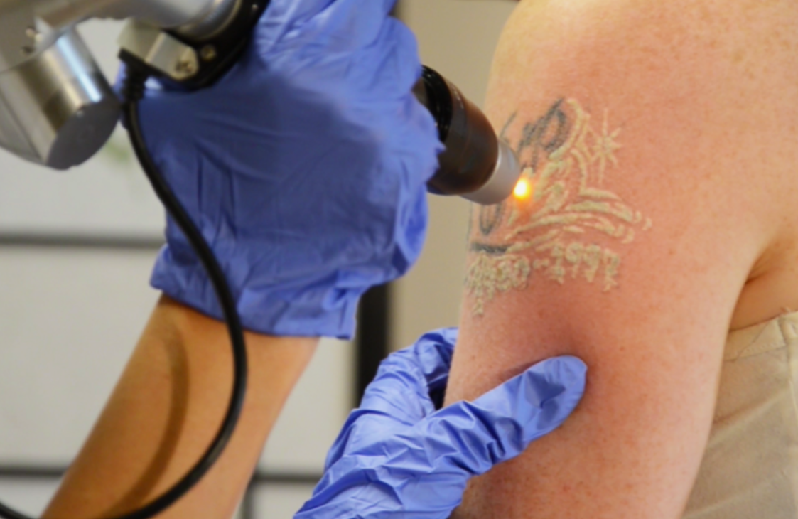 Laser tattoo removal by ink color in San Ramon, CA