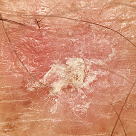 Image of patient struggling with Actinic Keratosis
