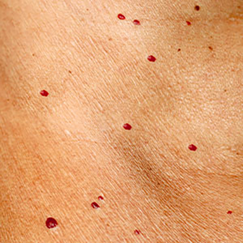 Image of patient struggling with Angiomas