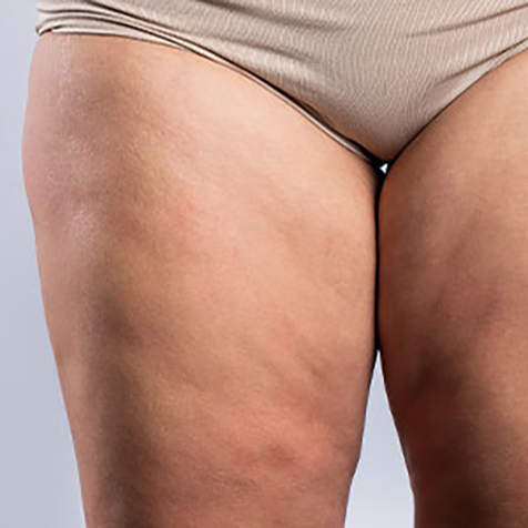 Cottage-cheese Thighs treatment options at SF Bay Cosmetic Surgery Medical Group in San Ramon, Pleasanton, San Jose, and Oakland