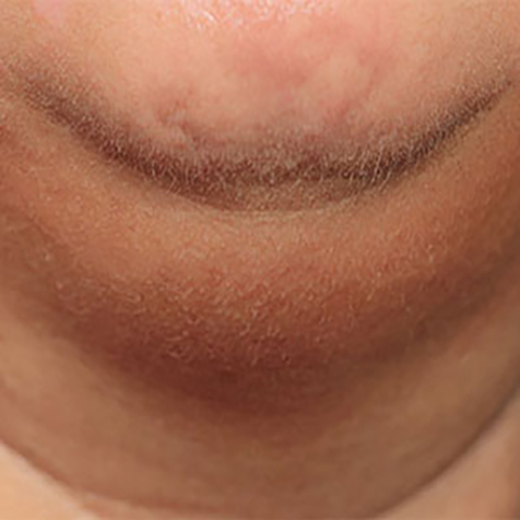 Double Chin treatment options at SF Bay Cosmetic Surgery Medical Group in San Ramon, Pleasanton, San Jose, and Oakland