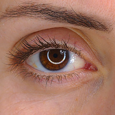 Image of patient struggling with Hollowed Eyes