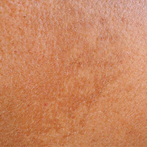 Image of patient struggling with Hyperpigmentation