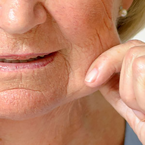 Image of patient struggling with Jowls