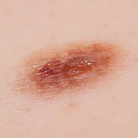 Image of patient struggling with Pigmented Lesions