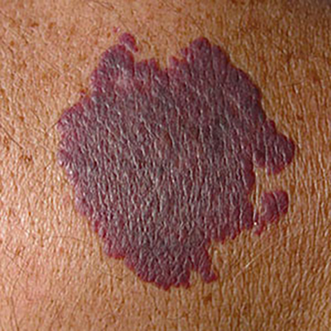 Port-Wine Stains treatment options at SF Bay Cosmetic Surgery Medical Group in San Ramon, Pleasanton, San Jose, and Oakland