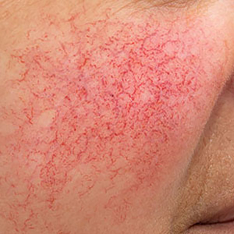 Image of patient struggling with Rosacea