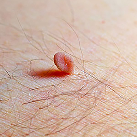 Image of patient struggling with Skin Tags