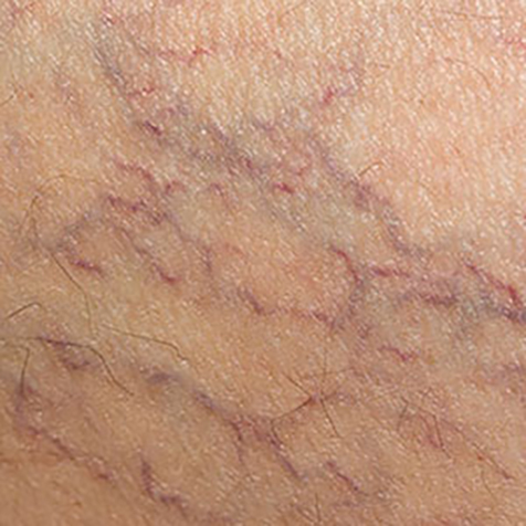 Spider Veins treatment options at SF Bay Cosmetic Surgery Medical Group in San Ramon