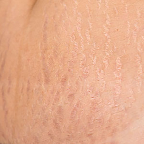 Image of patient struggling with Stretch Marks