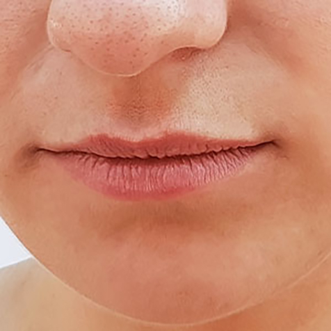 Image of patient struggling with Thin Lips