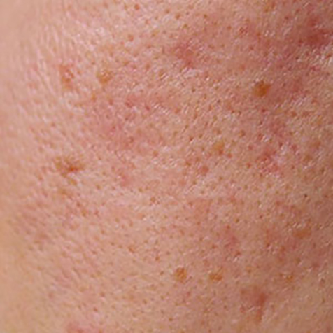 Image of patient struggling with Uneven Skin Texture