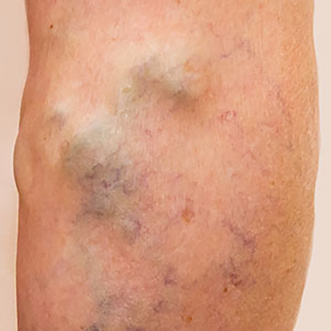 Image of patient struggling with Varicose Veins