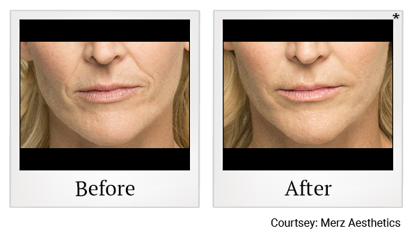Before and After Photo 1 of Belotero Balance® treatment at SF Bay Cosmetic Surgery Medical Group in San Ramon