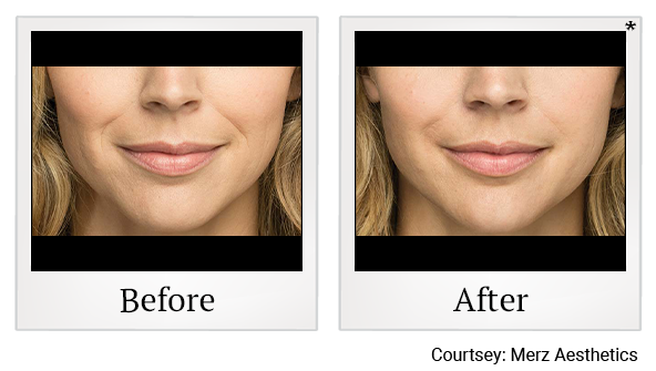 Before and After Photo 2 of Belotero Balance® treatment at SF Bay Cosmetic Surgery Medical Group in San Ramon, Pleasanton, San Jose, and Oakland