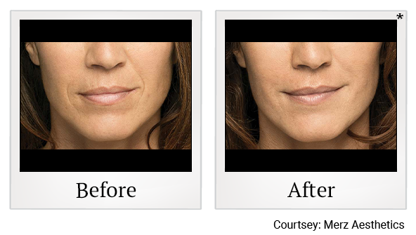 Before and After Photo 3 of Belotero Balance® treatment at SF Bay Cosmetic Surgery Medical Group in San Ramon
