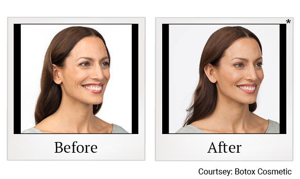 Before and After Photo 1 of Botox® treatment at SF Bay Cosmetic Surgery Medical Group in San Ramon