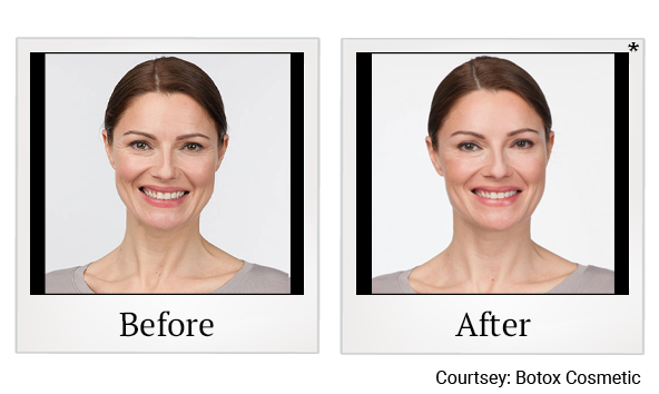 Before and After Photo 2 of Botox® treatment at SF Bay Cosmetic Surgery Medical Group in San Ramon