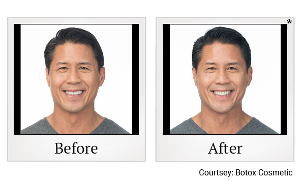 Before and After Photo 3 of Botox® treatment at SF Bay Cosmetic Surgery Medical Group in San Ramon, Pleasanton, San Jose, and Oakland