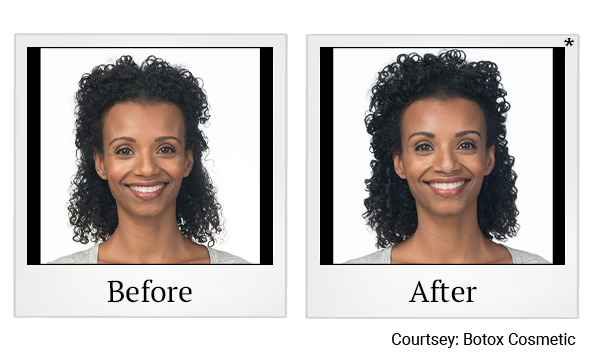 Before and After Photo 4 of Botox® treatment at SF Bay Cosmetic Surgery Medical Group in San Ramon, Pleasanton, San Jose, and Oakland