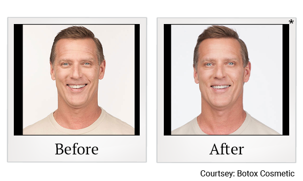 Before and After Photo 5 of Botox® treatment at SF Bay Cosmetic Surgery Medical Group in San Ramon, Pleasanton, San Jose, and Oakland