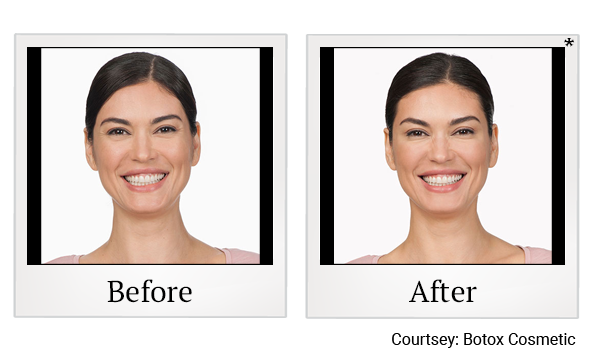 Before and After Photo 7 of Botox® treatment at SF Bay Cosmetic Surgery Medical Group in San Ramon