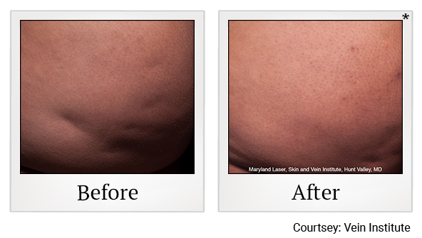 Before and After Photo 2 of Cellfina® treatment at SF Bay Cosmetic Surgery Medical Group in San Ramon