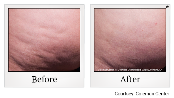 Before and After Photo 3 of cellfina treatment at SF Bay Cosmetic Surgery Medical Group in San Ramon