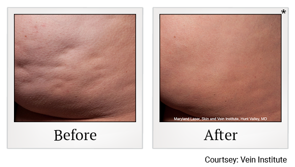 Before and After Photo 4 of cellfina treatment at SF Bay Cosmetic Surgery Medical Group in San Ramon