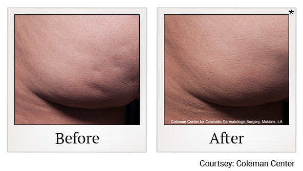 Before and After Photo 5 of Cellfina® treatment at SF Bay Cosmetic Surgery Medical Group in San Ramon
