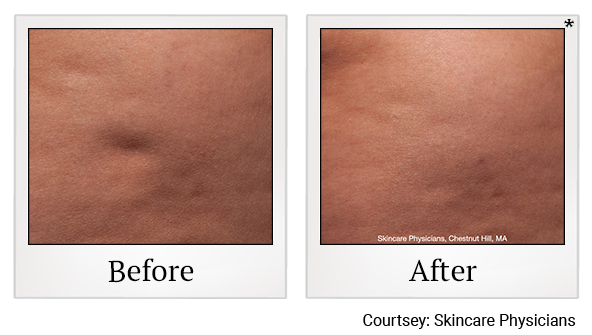Before and After Photo 6 of cellfina treatment at SF Bay Cosmetic Surgery Medical Group in San Ramon