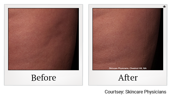 Before and After Photo 7 of Cellfina® treatment at SF Bay Cosmetic Surgery Medical Group in San Ramon