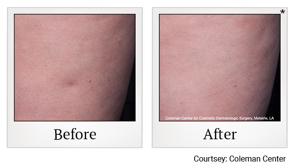 Before and After Photo 8 of Cellfina® treatment at SF Bay Cosmetic Surgery Medical Group in San Ramon