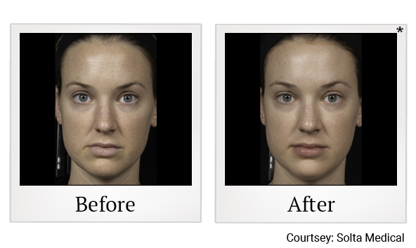 Before and After Photo 1 of Clear + Brilliant® treatment at SF Bay Cosmetic Surgery Medical Group in San Ramon, Pleasanton, San Jose, and Oakland