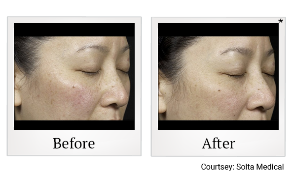 Before and After Photo 3 of Clear + Brilliant® treatment at SF Bay Cosmetic Surgery Medical Group in San Ramon, Pleasanton, San Jose, and Oakland