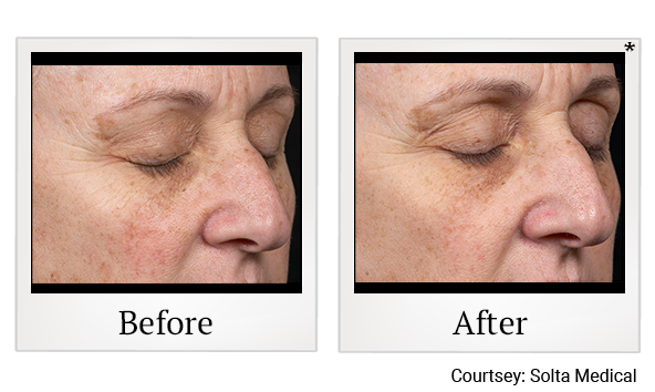 Before and After Photo 4 of Clear + Brilliant® treatment at SF Bay Cosmetic Surgery Medical Group in San Ramon