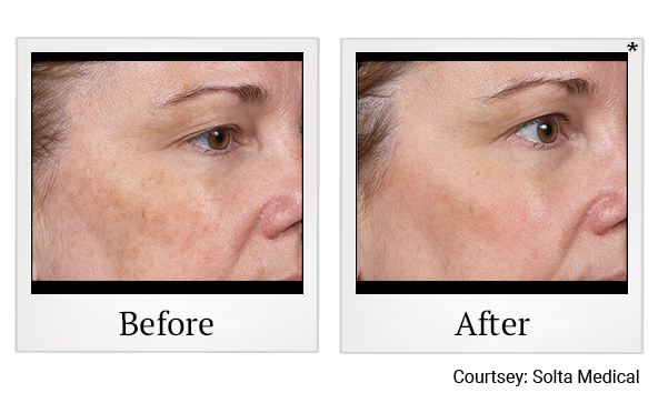 Before and After Photo 5 of Clear + Brilliant® treatment at SF Bay Cosmetic Surgery Medical Group in San Ramon, Pleasanton, San Jose, and Oakland