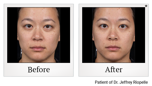 Before and After Photo 1 of Clear + Brilliant® treatment at SF Bay Cosmetic Surgery Medical Group in San Ramon, Pleasanton, San Jose, and Oakland