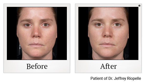 Before and After Photo 9 of Clear + Brilliant® treatment at SF Bay Cosmetic Surgery Medical Group in San Ramon, Pleasanton, San Jose, and Oakland