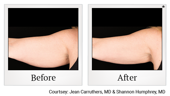 Before and After Photo 1 of Coolsculpting® treatment at SF Bay Cosmetic Surgery Medical Group in San Ramon