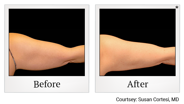 Before and After Photo 10 of Coolsculpting® treatment at SF Bay Cosmetic Surgery Medical Group in San Ramon