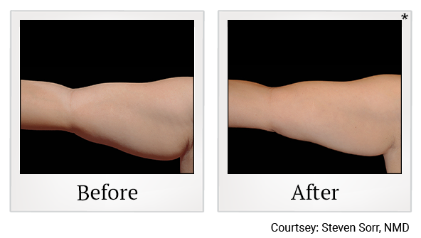 Before and After Photo 11 of Coolsculpting® treatment at SF Bay Cosmetic Surgery Medical Group in San Ramon